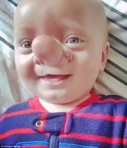 This baby’s nickname was Pinocchio and check out what he looks like years later…