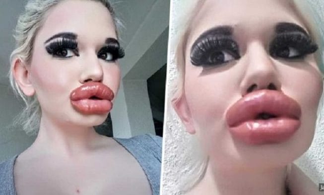 This Girl Who Is 22, Spends Thousands On Lip Injections To Have The ...