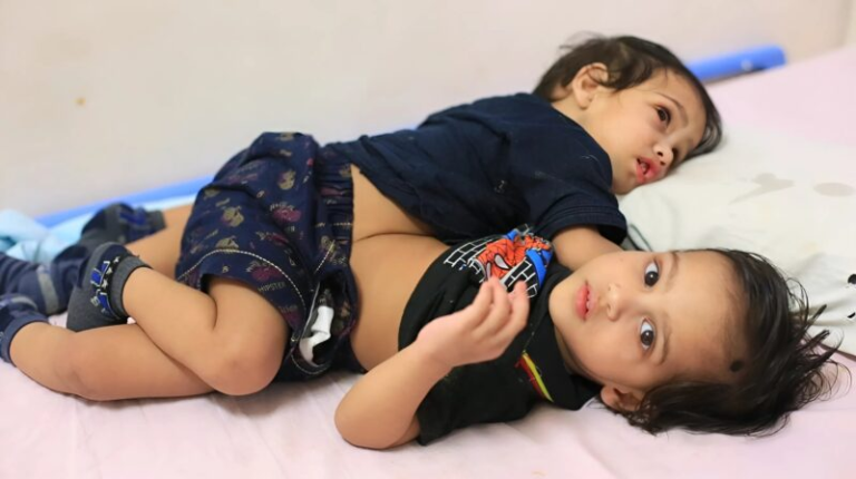 They had one liver, one bladder and one stomach for both of them: photos of Siamese twins from India after surgery are shocking